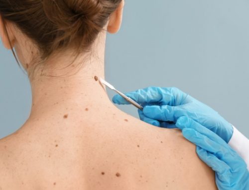 At-home skin cancer diagnosis & treatment: Is it safe?